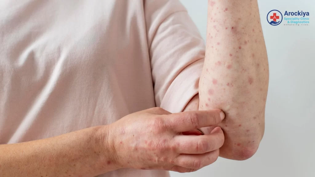 Person scratching chickenpox rash on arm - How to Remove Deep Chicken Pox Scars Naturally by Arockiya Clinic